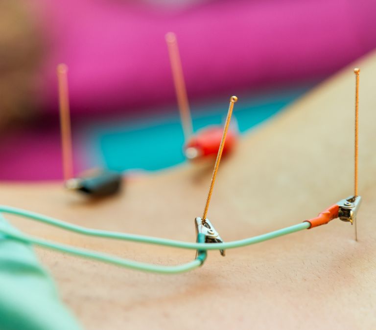 How Acupuncture Can Improve Menopause Symptoms
