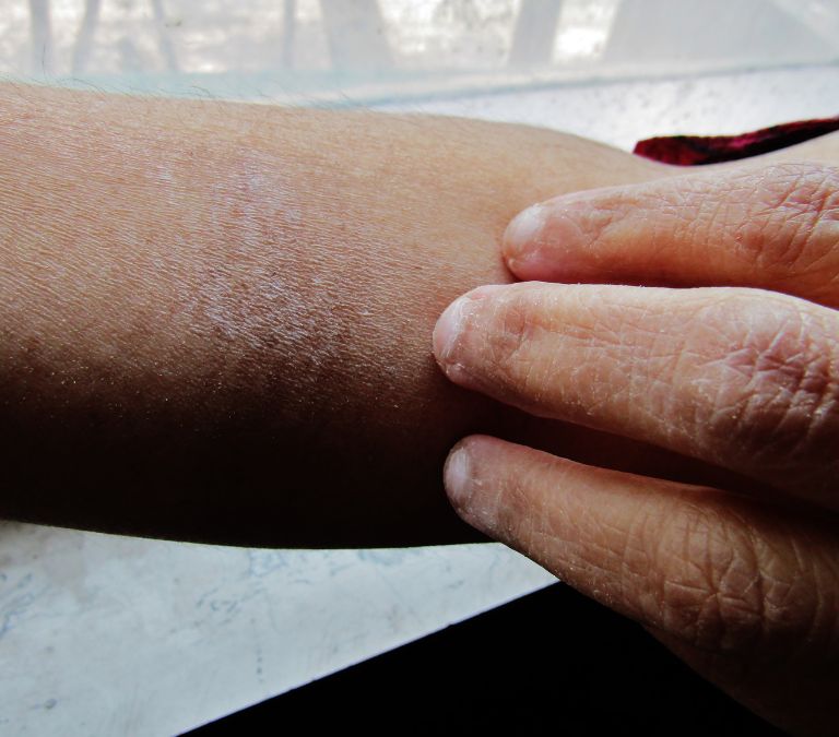 How To Prevent Dry Skin And Associated Problems During Menopause