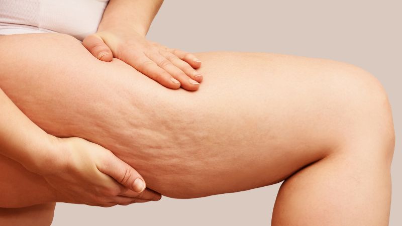 liposuction for cellulite reduction